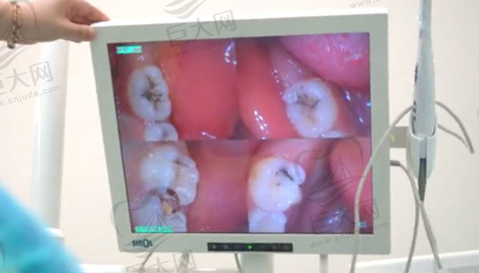 口腔可视化系统投影儿童龋齿细节图
