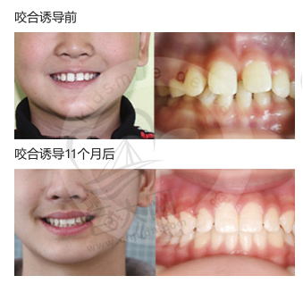 儿童深覆盖矫正11个月后效果图