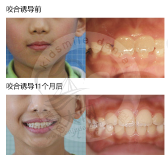 儿童深覆合 矫正11个月后效果图