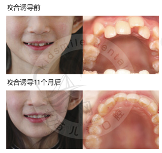 儿童牙齿拥挤矫正11个月后效果图
