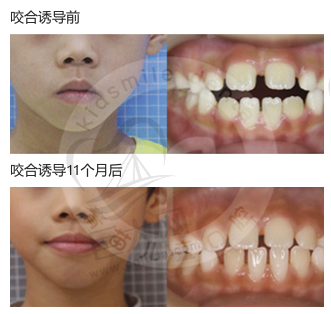 儿童门牙缝隙过大矫正11个月后效果图
