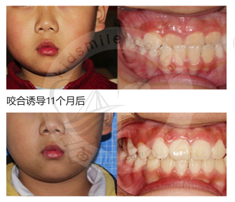 儿童地包天”或“兜齿”矫正11个月后效果图