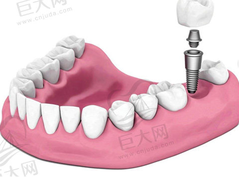 天津哪家口腔医院做种植技术好呢？