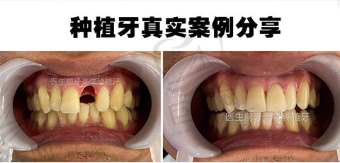 天津美奥口腔权圣凤院长种植牙案例分享