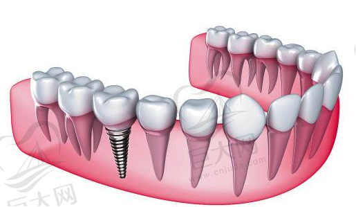 种植牙示意图