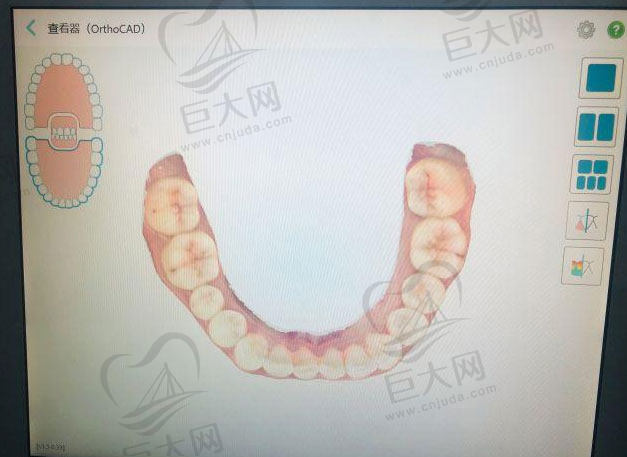 福斯曼牙齿隐形矫正技术的黑科技iTero 3D口扫