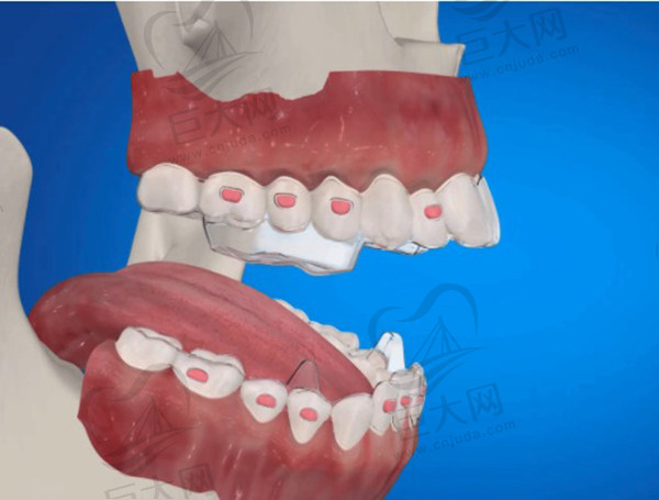 正雅隐形矫正过程图
