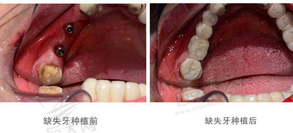 江西九江中山口腔医院即刻种植牙案例效果分享