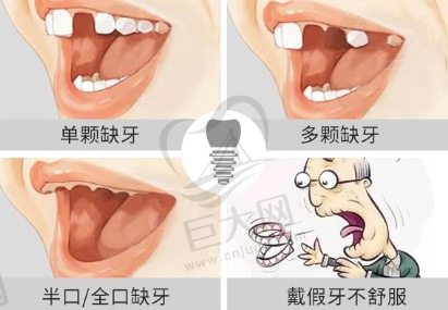 种植牙解决牙缺失问题