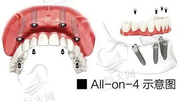 北京优贝口腔ALL-ON-4种植牙怎么样？