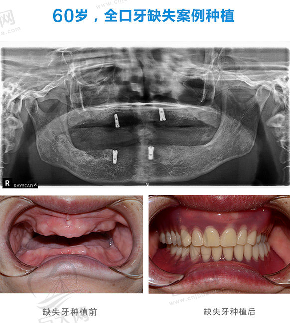 来看60岁老人在北京优贝口腔找郭宏伟院长做的ALL-ON-4种植牙案例效果怎么样？