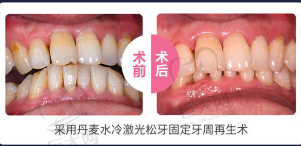 做过丹麦水冷激光患者评价