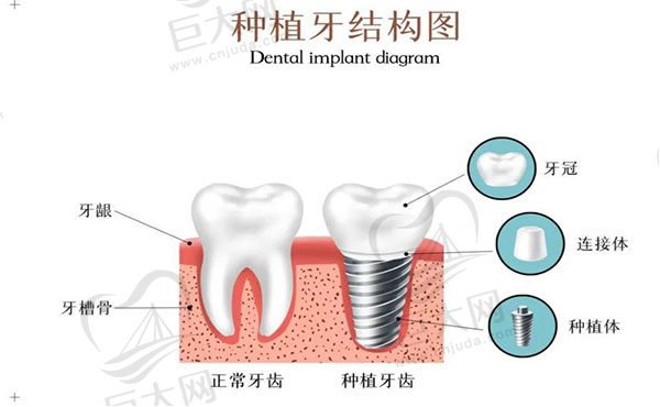种植牙结构图
