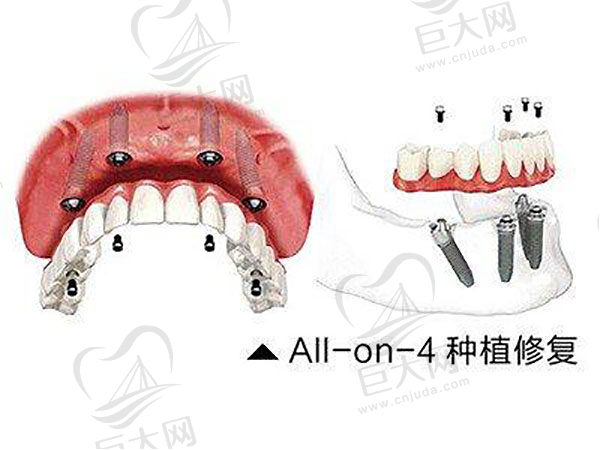 all-on-4种植技术