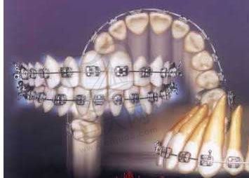 OPA-K直丝弓自锁正畸技术优势解说图