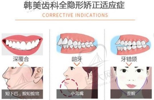 韩美齿科隐形矫正适应症