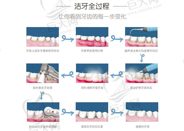 洁牙全过程