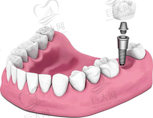 种植牙示意图