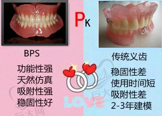 bps吸附性义齿和普通假牙有什么区别?