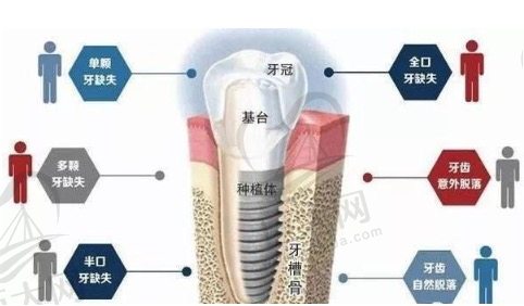 种植牙的组成