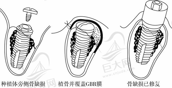 GBR骨再生植联合系统种植