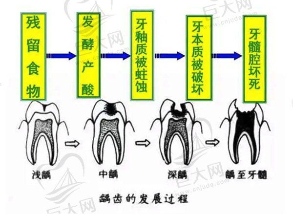 龋齿发展过程