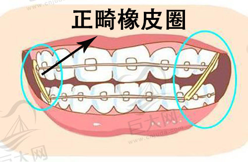 正畸牵引橡皮圈有什么作用