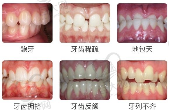 需要牙齿矫正的情况