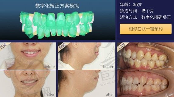 麦芽口腔矫正牙齿前后效果对比