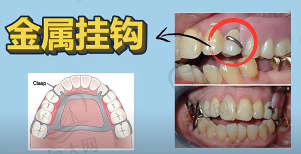 活动性假牙