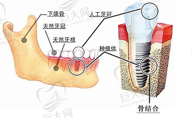 保定合众口腔门诊特色项目种植牙