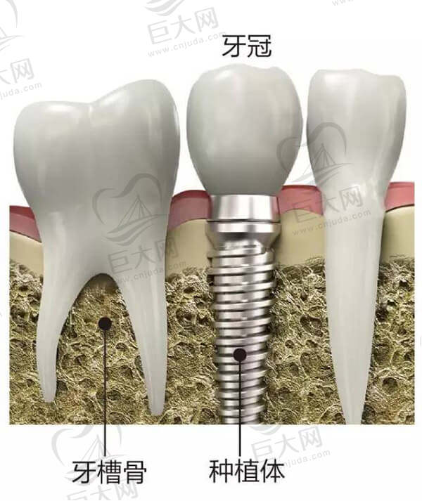 种植牙结构图