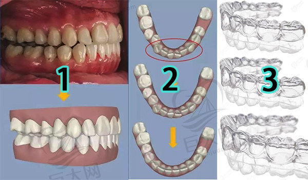 隐形牙套制作过程步骤