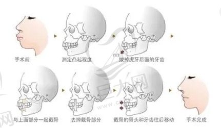 正颌手术过程