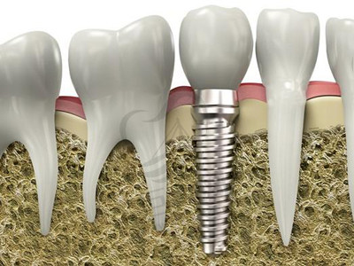 种植牙示意图