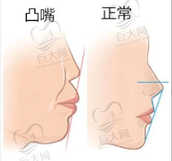 凸嘴颌正常面型对比