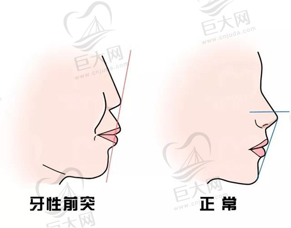 牙性前突和正常牙齿对比图