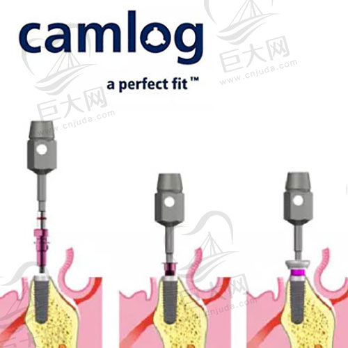 德国camlog种植牙示意图