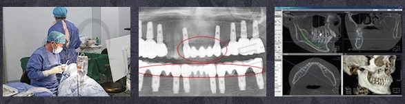 种植牙术前检查