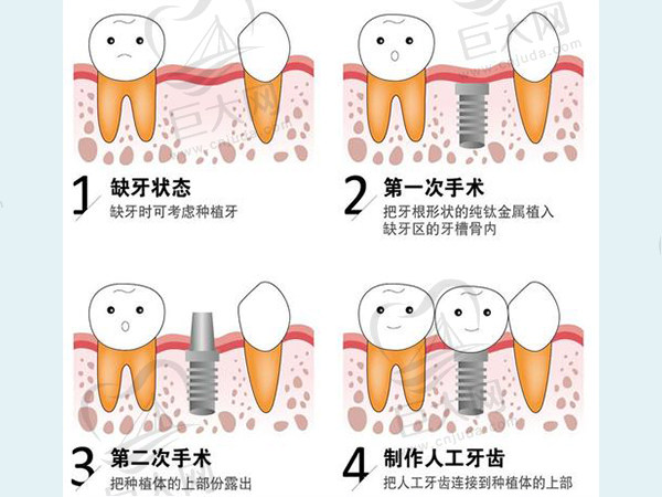 种植牙过程示意图