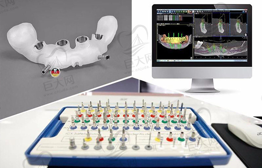 济宁壹颗芽口腔3d导板种植牙