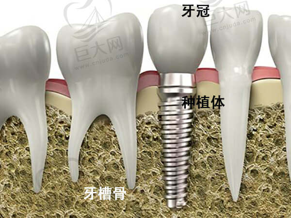 种植牙示意图