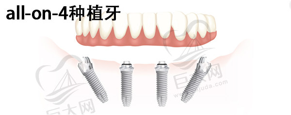 All-on-4种植牙