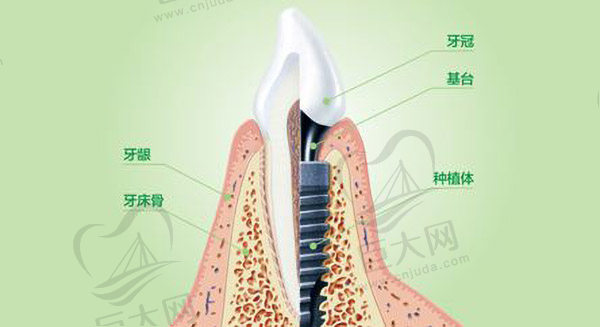 种植牙的构成