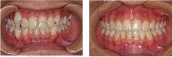 牙齿矫正效果图