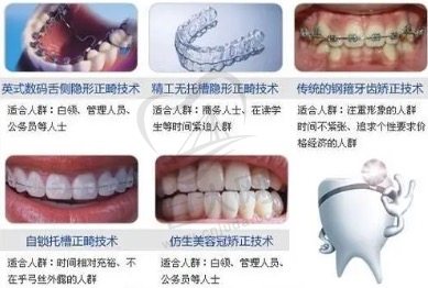 牙齿矫正的方式