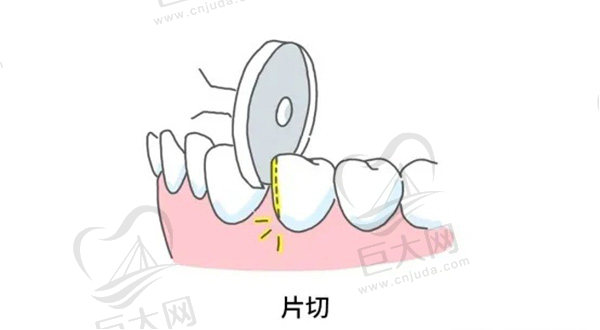 矫正牙齿片切过程