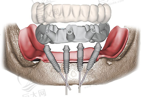 即刻负重ALL-ON-4速导种植牙