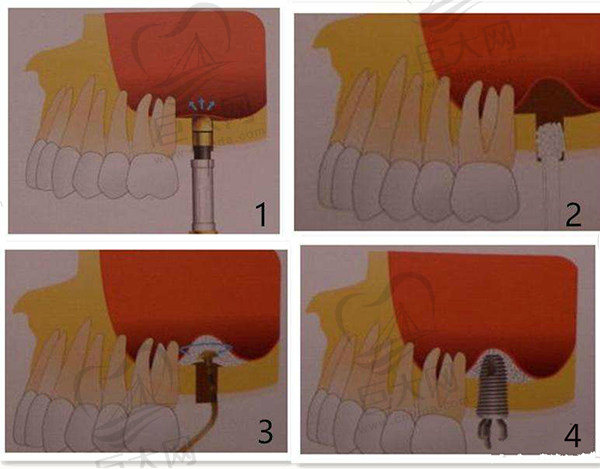 上颌窦提升术过程图
