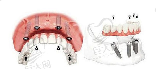 all-on-4全口种植牙